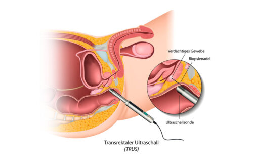 Transrektaler Ultraschall (TRUS), Darstellung der Ultraschalluntersuchung zur Biopsie von verdächtigem Gewebe. Die Abbildung zeigt die Verwendung einer Ultraschallsonde und Biopsienadel im Beckenbereich.