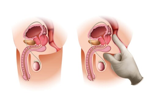 Anatomische Darstellung des männlichen Fortpflanzungssystems mit Hervorhebung der Prostata und deren Funktion. Die Abbildung zeigt die Umrisse des Penis, der Hoden und des Samenleiters, sowie eine Hand in einem Untersuchungshandschuh, die auf die Prostata zeigt.